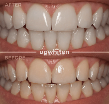 Teeth whitening before and after comparison in Ottawa (5)