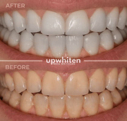 Teeth whitening before and after comparison in Ottawa (2)