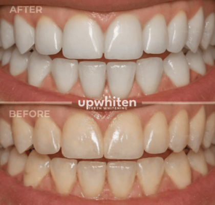 Teeth whitening before and after comparison in Ottawa (1)